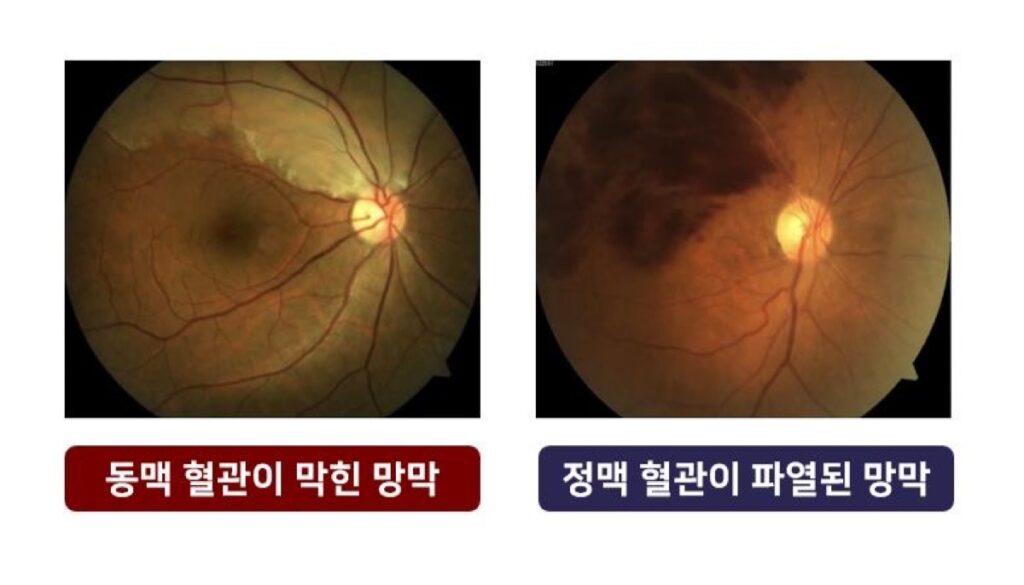 까딱하면 실명? "뇌졸중만 주의할 게 아니었네"…노년층들 '이럴 수가' 2 망막혈관폐쇄증