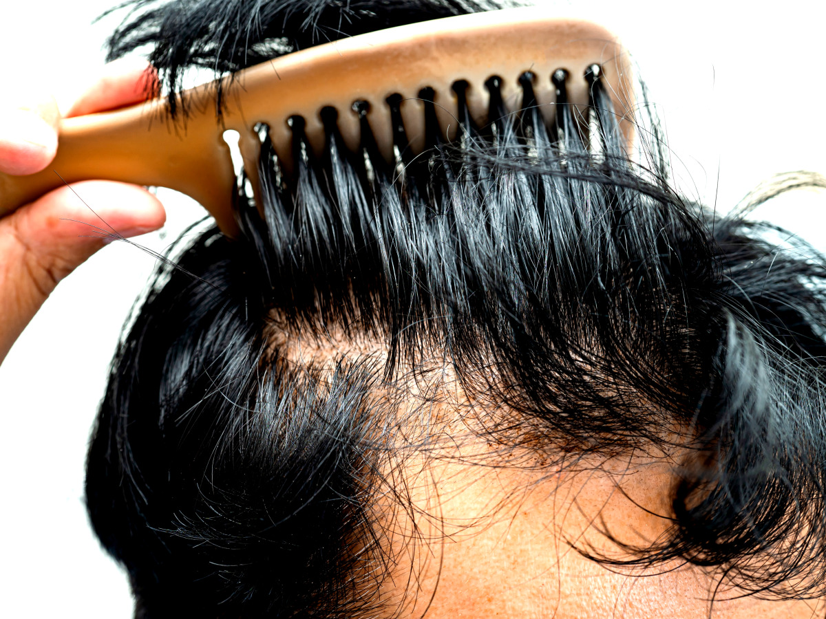 부푼 꿈에 기대했는데 “두 눈 뜨고 당했다”…1000만 탈모인 '발칵' 뒤집힌 이유 1 탈모